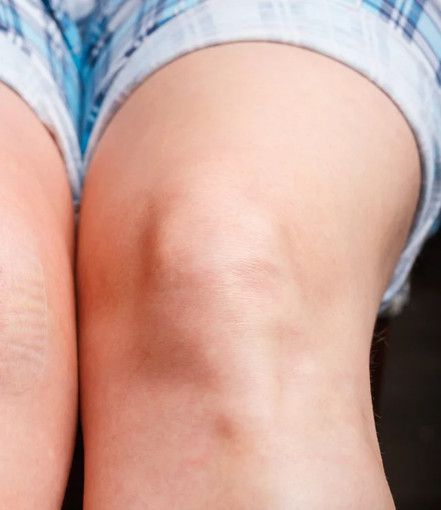 Dark Knee problem