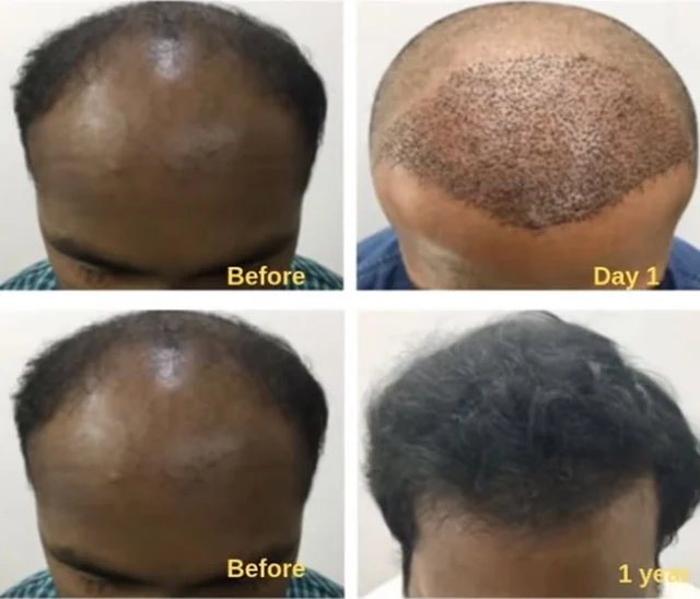 ஊசிபோட்டால் தலைமுடி வளருமா...? #HairGrowthwithoutSurgery