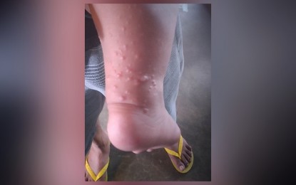 Eastern Visayas HFMD cases not alarming, says DoH