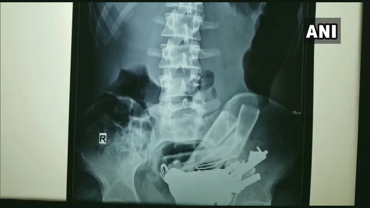 X Ray of the patient