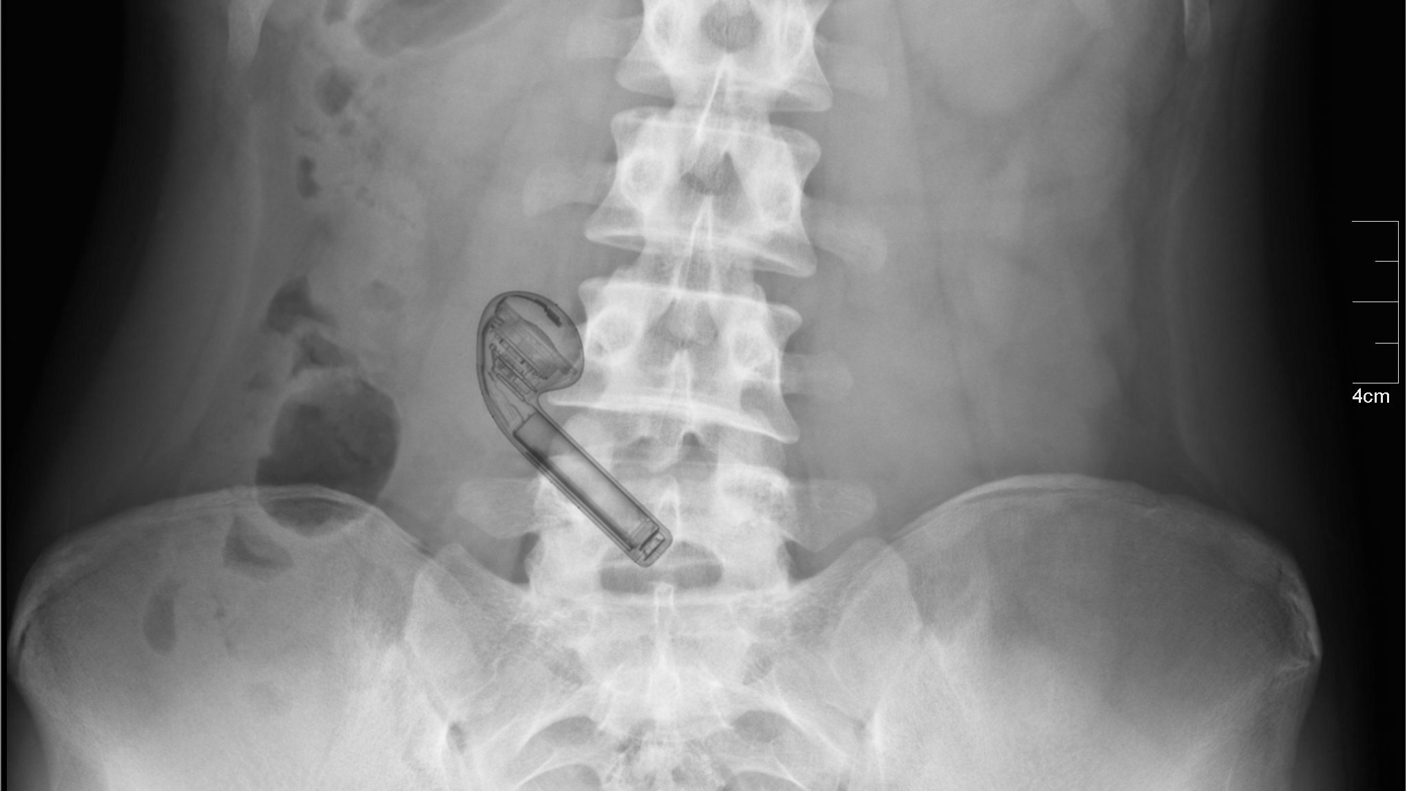 Apple Airpod as X' mas gift lands up in 7-yr-old's stomach