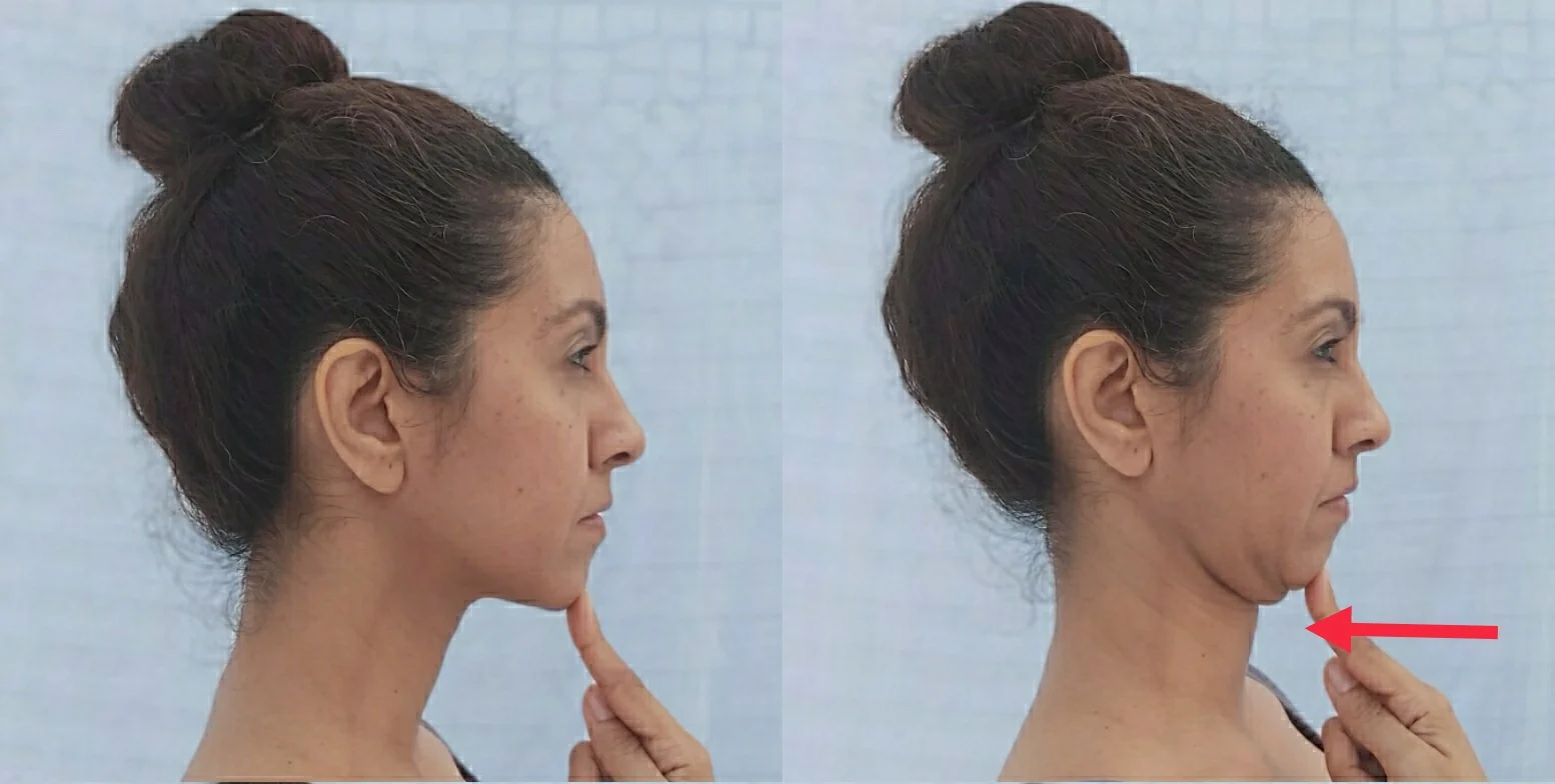 Chin Tuck Exercise: From your natural neck position tuck your chin back as
if you are trying to give yourself a double chin. Hold this position for five seconds and then repeat 10 times. Awareness of your chin position should be corrected multiple times a day in order to correct the habit.