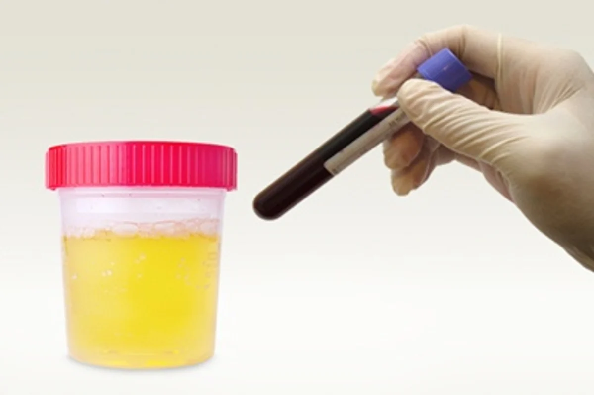 Blood And Urine Tests Developed To >> New Economic Urine Test May Replace Need For Blood Samples Blood And Urine Tests Developed To >> New Economic Urine Test May Replace Need For Blood Samples