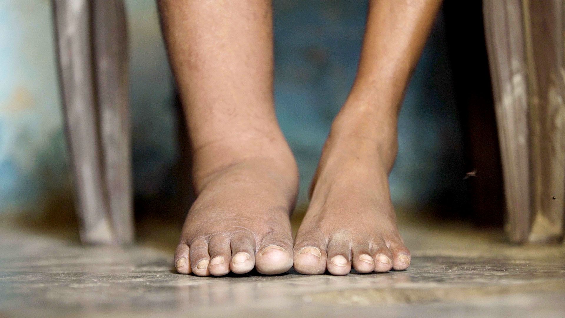 Bhopal: Union minister launches Filariasis eradication program in Tikamgarh and Niwari districts - Vimarsana News