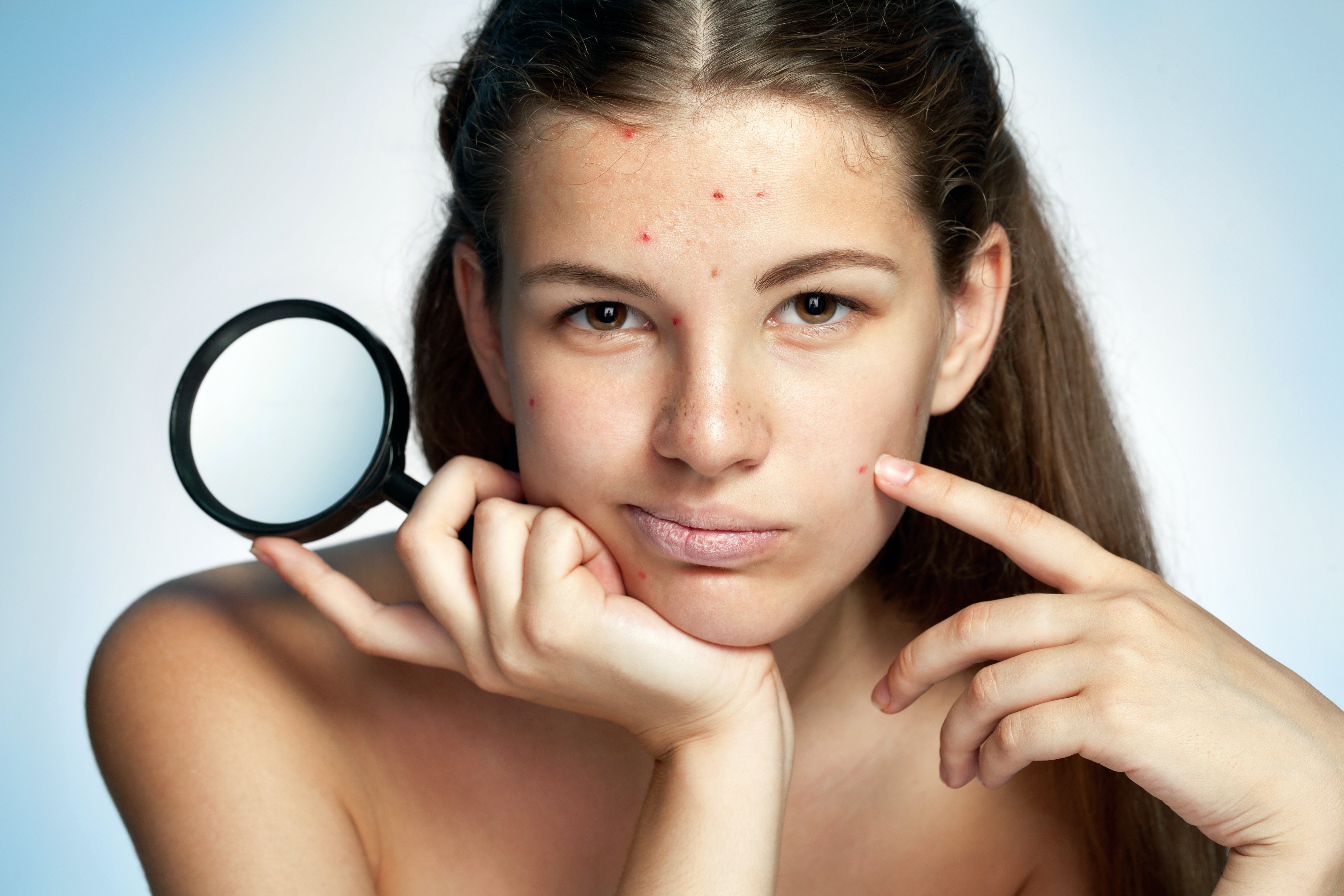 Scientists find a novel strain of acnes that promotes skin health - Vimarsana News