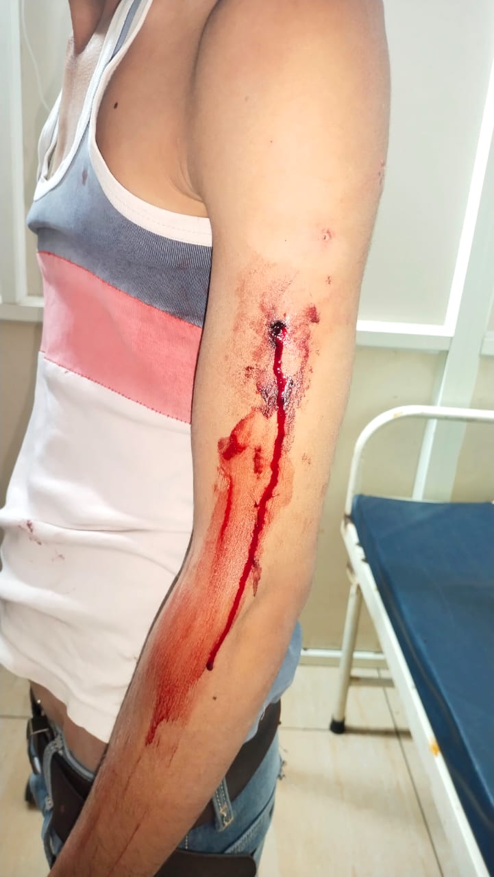 Hatpipliya: Youth injured in attack by wild animal - Vimarsana News