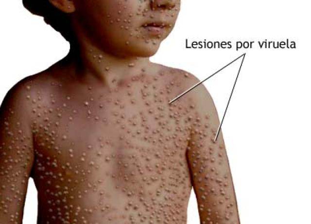 Singapore Reports First Case Of Monkeypox Virus