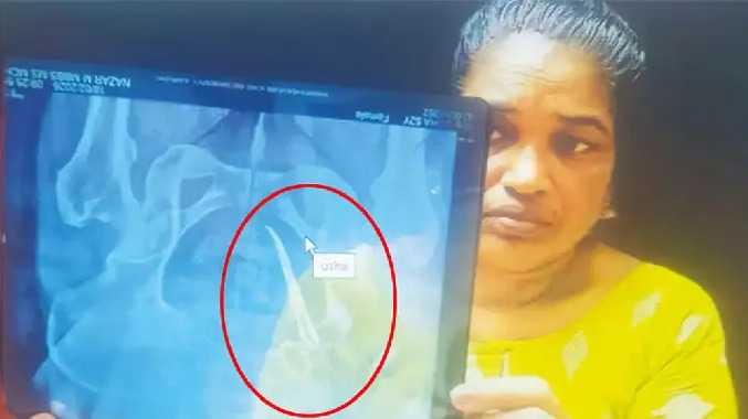 பெண்ணின் வயிற்றில் இருந்த 10 செ.மீ. நீள கத்தரிக்கோல்
