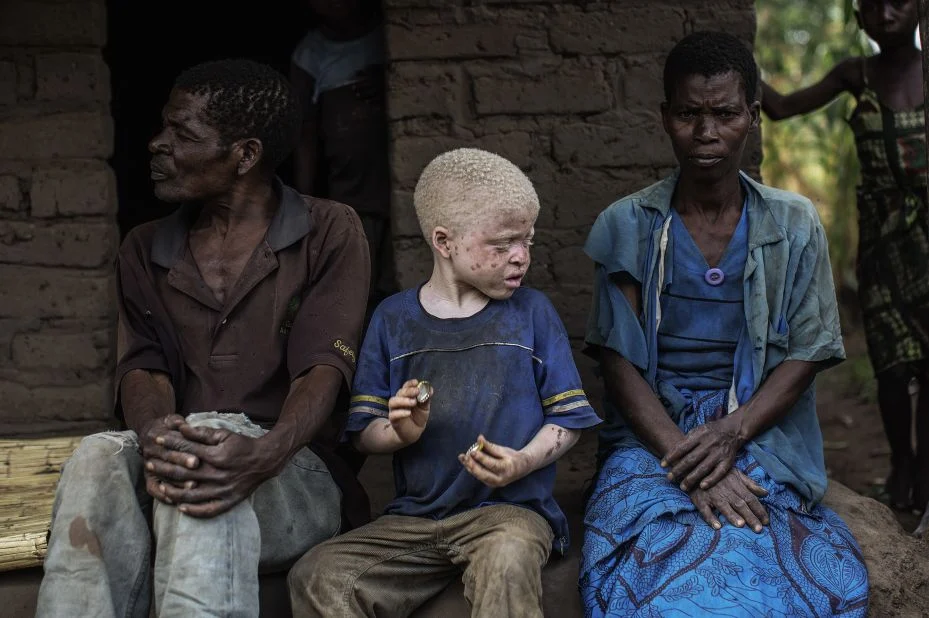 Attempted Lynching of Albino Killer Leaves One Dead in Central Mozambique