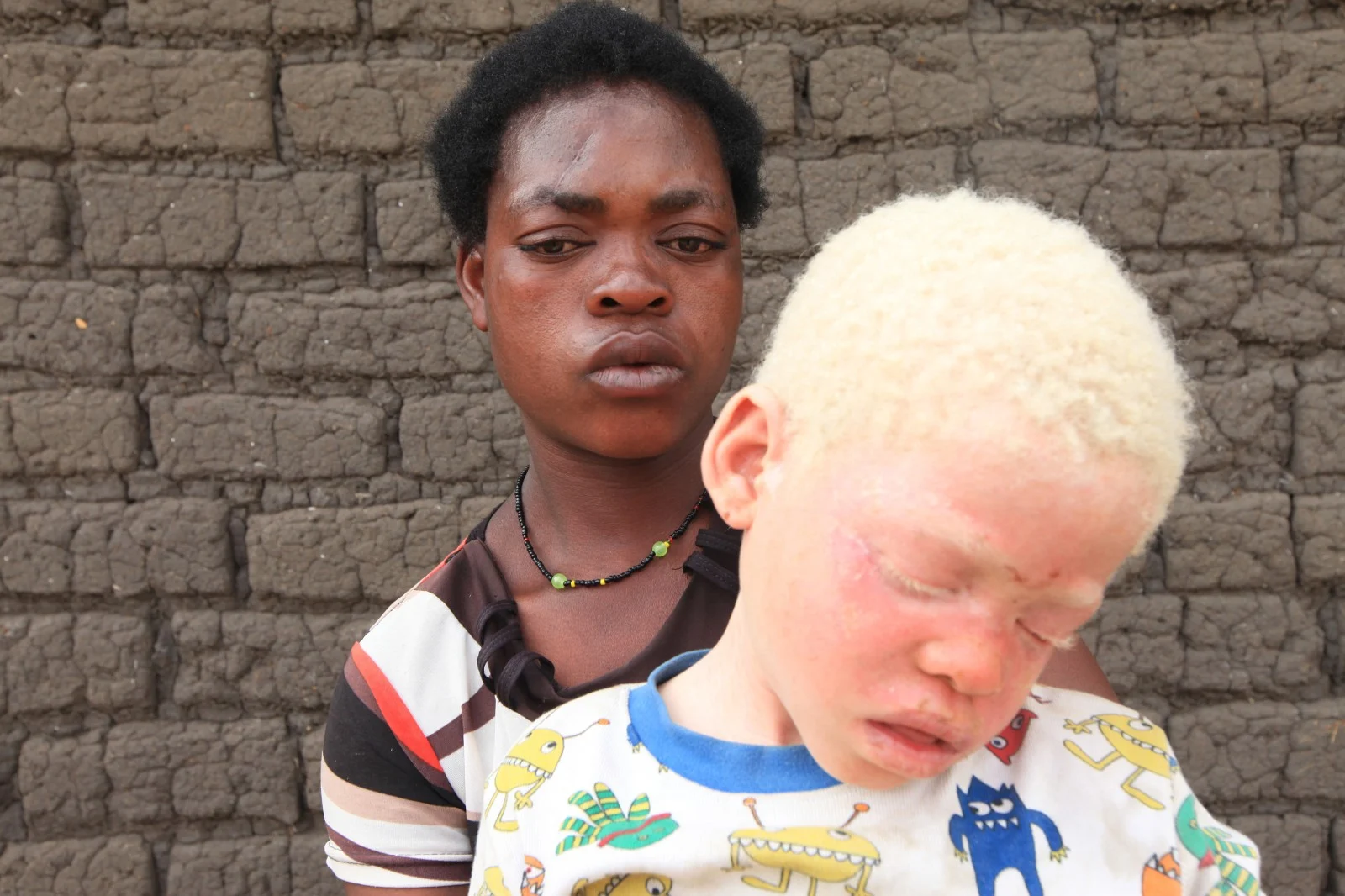 81 Angolan Albino Families Receive Assistance From Social Protection Program