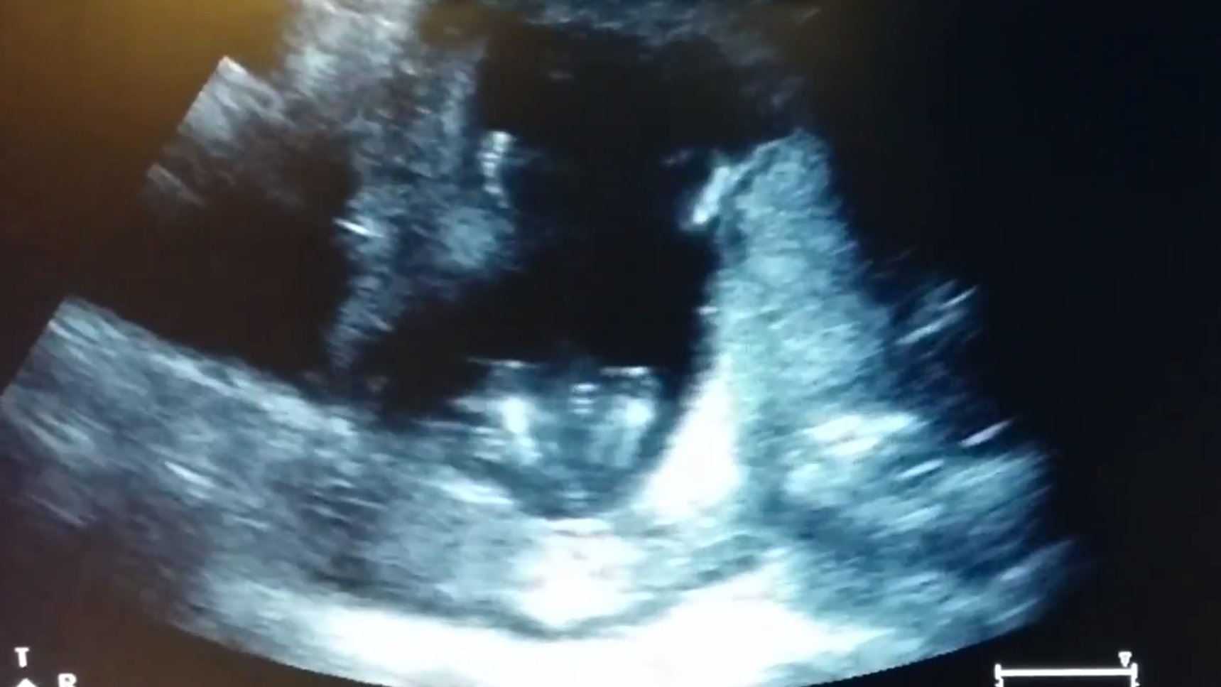 Preggers Cam! Baby Claps Inside Mum’s Womb, Seen on Ultrasound The Quint