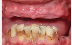 7 of 10 Pinoys suffer from dental caries