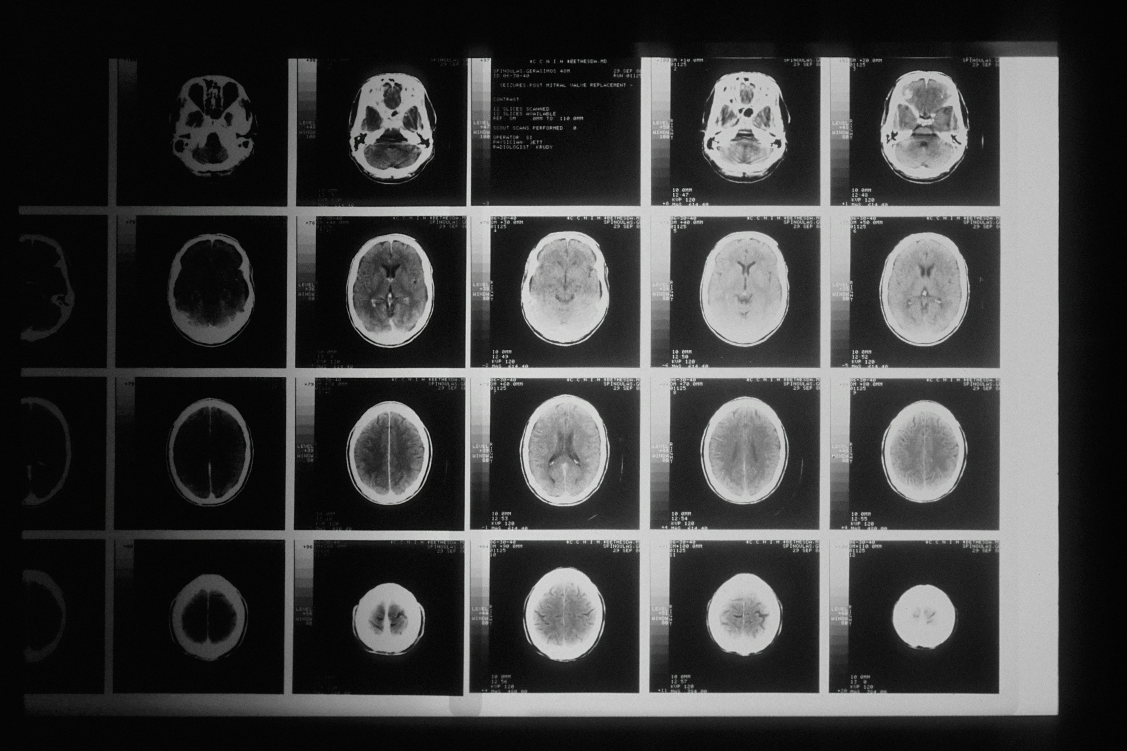 First child cured of rare brain tumour 'offers real hope'