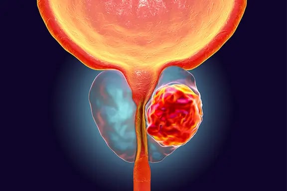 Prostate cancer among
pressing health issues