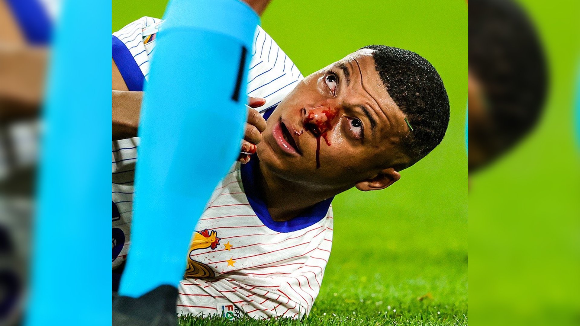 BLOODY PERFORMANCE: France edges Austria as Mbappe suffers broken nose