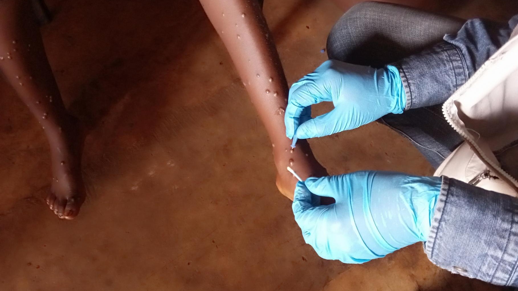 Smallpox vaccine could be used vs. Mpox -- DOH