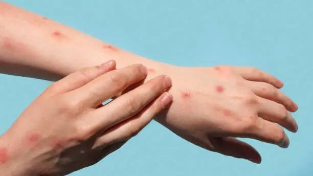 Public warns vs. 'imported' mpox vaccines sans DOH, FDA safeguards