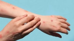 Public warns vs. 'imported' mpox vaccines sans DOH, FDA safeguards