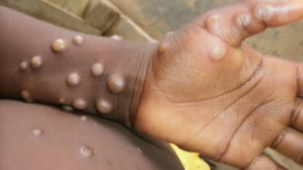 Uganda reports first two cases 
of monkeypox