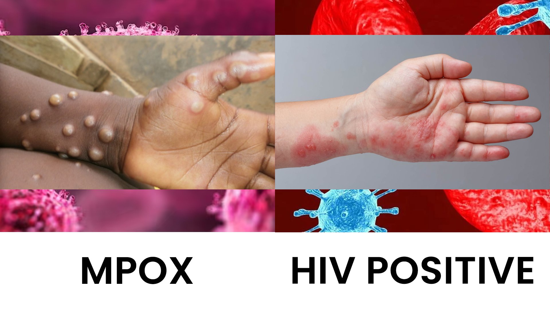 Monkeypox, HIV not connected