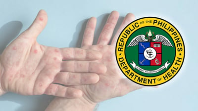 DOH: Mpox cases in Phl still mild