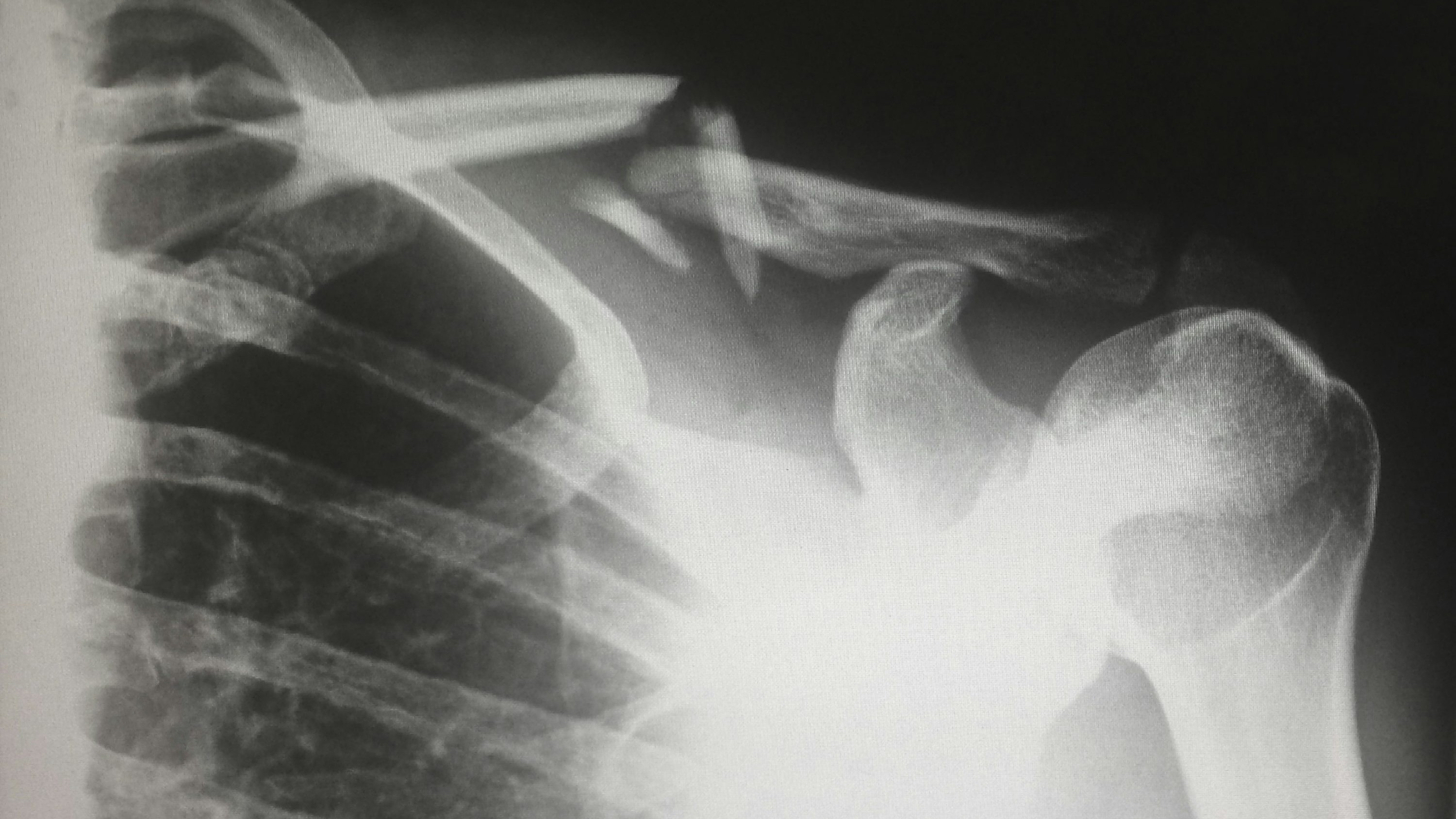 Filipino researchers develop affordable bone fracture treatment