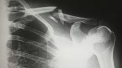 Filipino researchers develop affordable bone fracture treatment