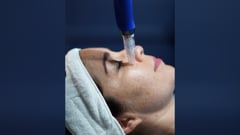 Next level of micro needling