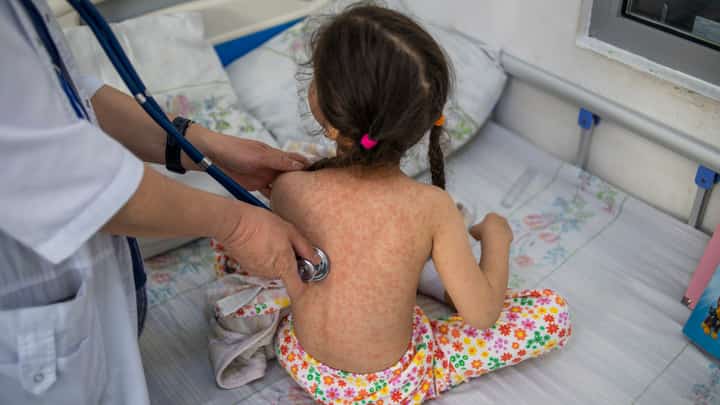 Two dead, 200 sickened in U.S. measles outbreak: authorities