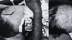 Suspected monkeypox case reported in Lanao del Sur — contact tracing underway