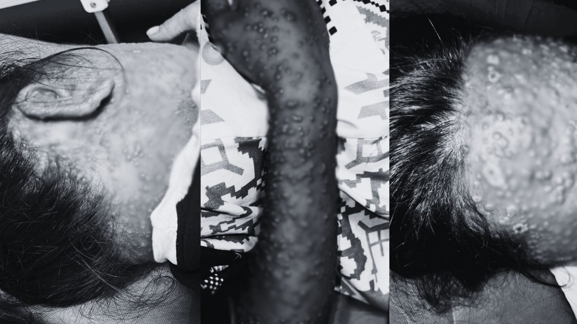 Suspected monkeypox case reported in Lanao del Sur — contact tracing underway