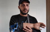 Bangladeshi students who lost their hands during protests to overthrow the government in August have been fitted with robotic replacements