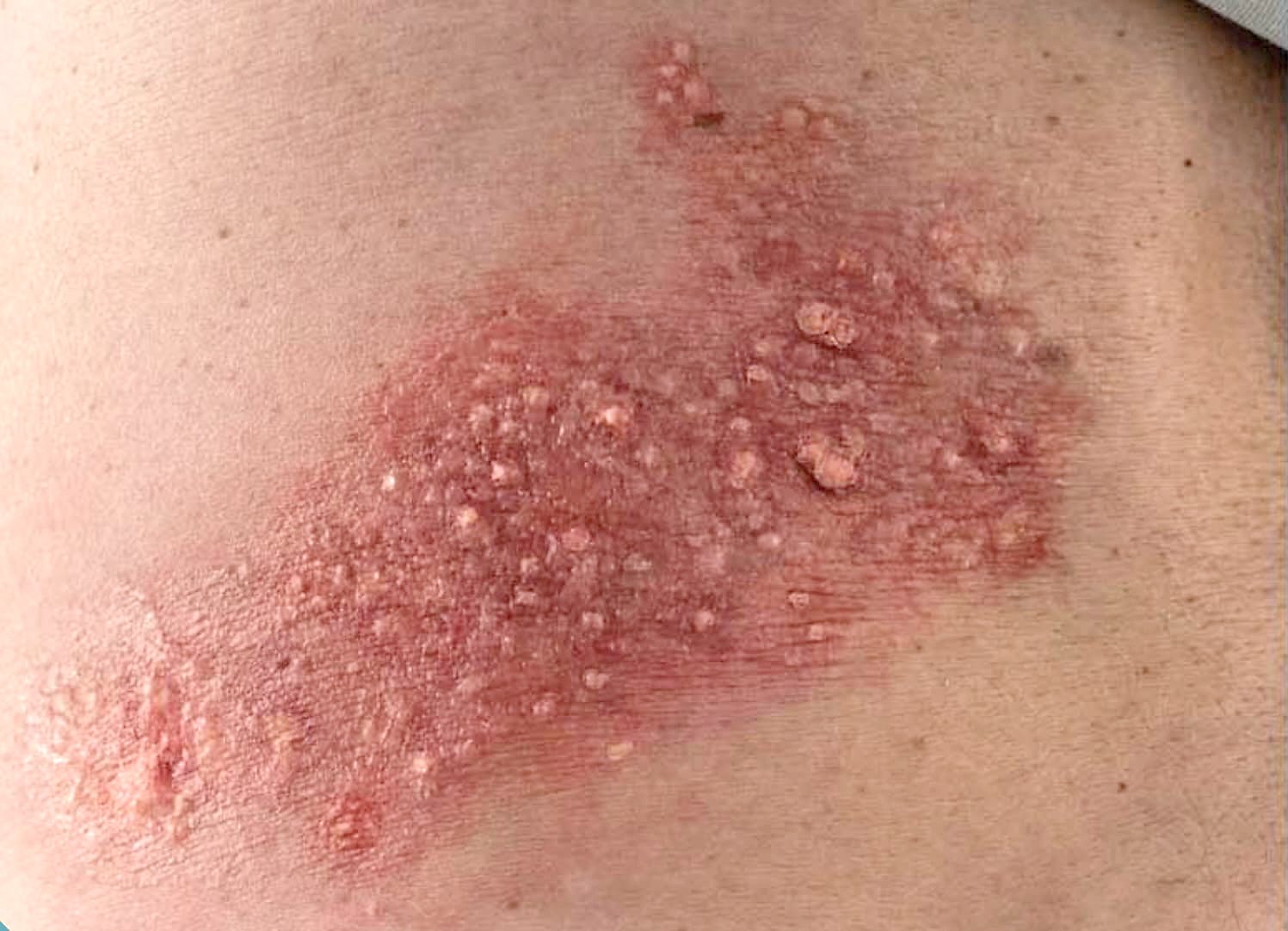 Shingles: Hidden threat among Cebuanos aged 50-above