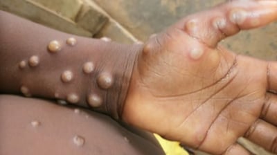 Baguio stands guard vs mpox