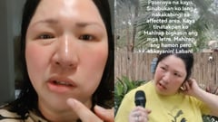 Frenchie Dy opens up about battling Bell’s Palsy