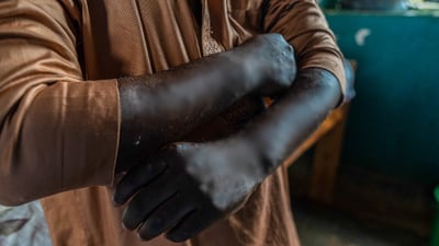 WHO decides mpox epidemic still global health emergency
