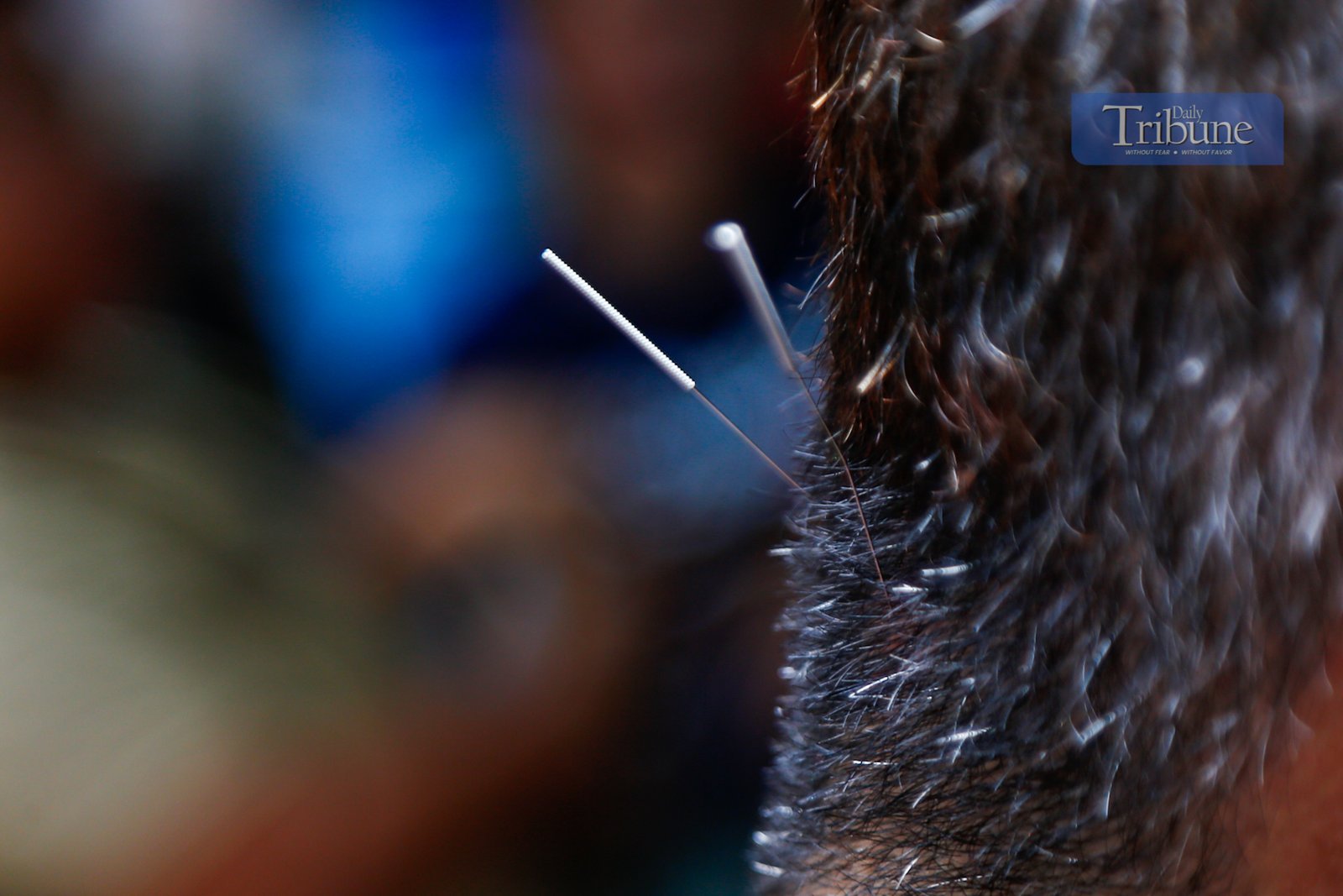 Free acupuncture