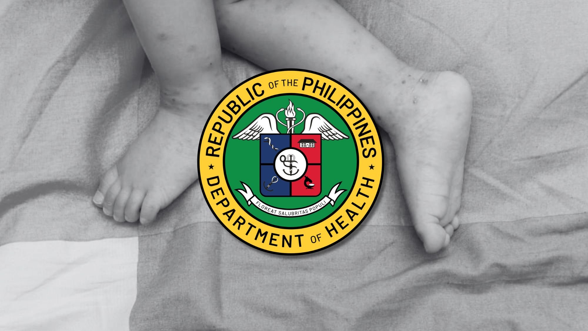 DOH logs 2,525 new hand, foot, and mouth disease cases in one week