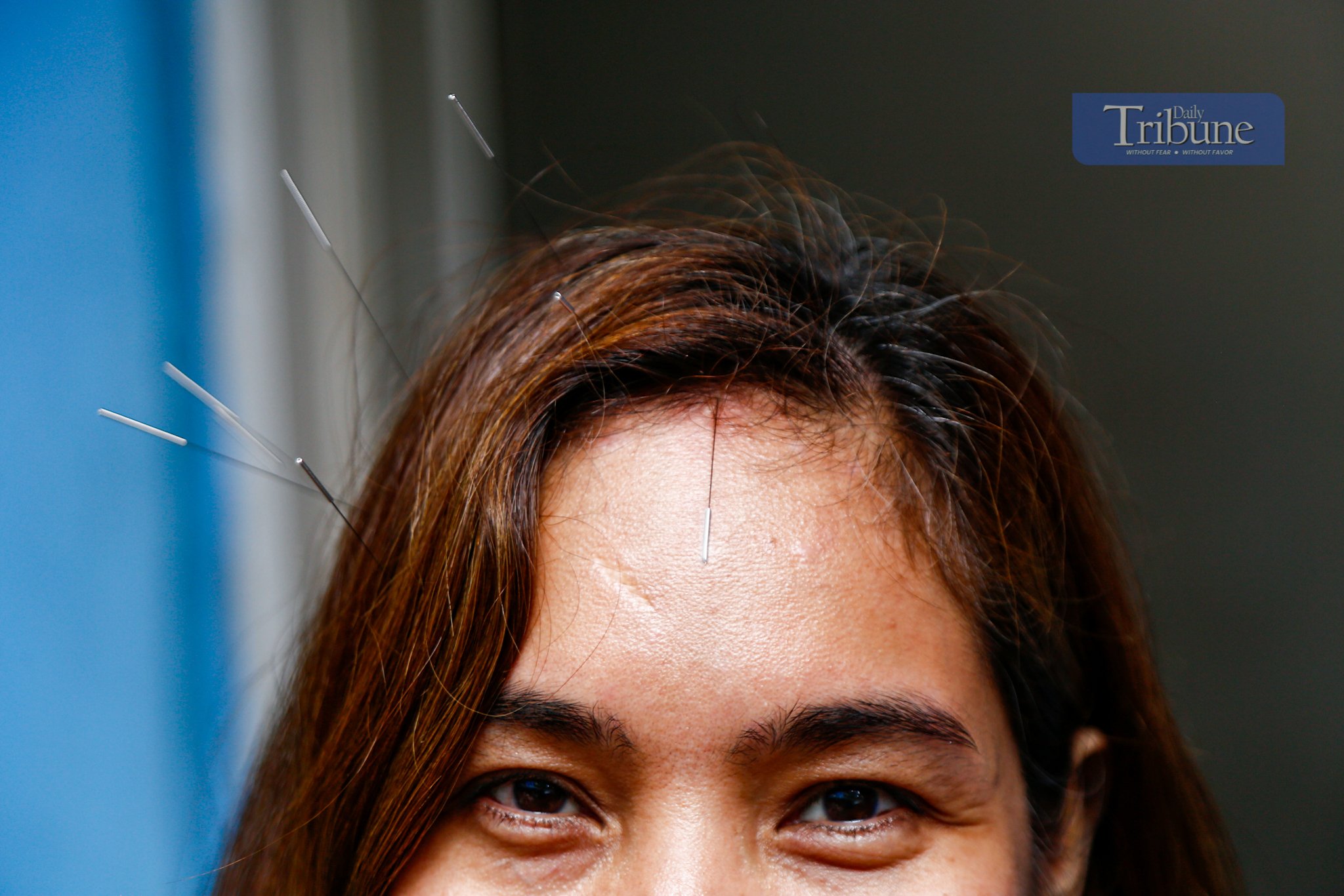 Free acupuncture sessions 