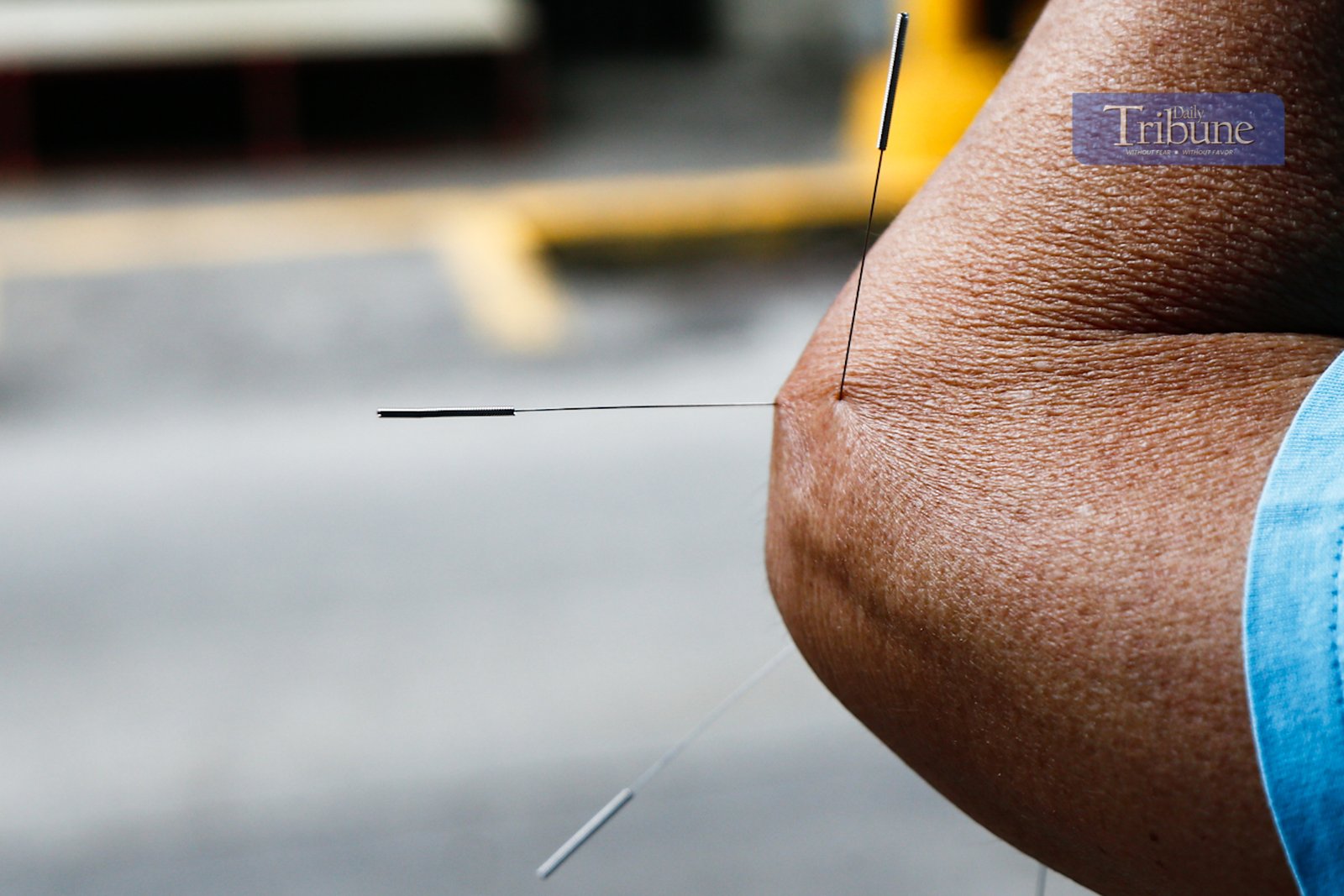 Free acupuncture