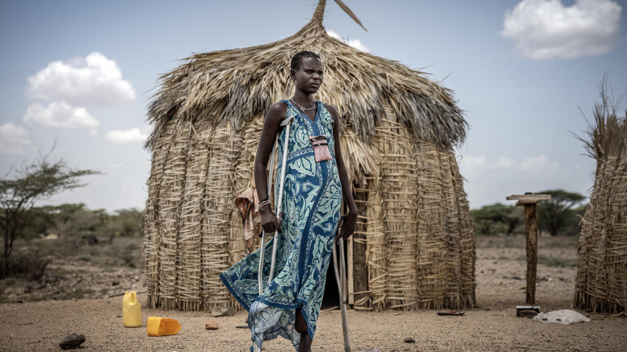 Rare bone-eroding disease ruining lives in Kenya’s poorest county