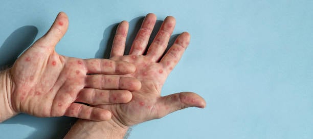 Mpox vaccine supply still limited — PSMID