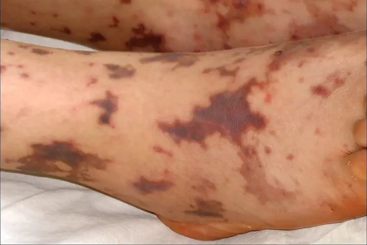 Health experts warns 
vs deadly Meningococcal disease