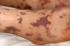 Health experts warns
vs deadly Meningococcal disease