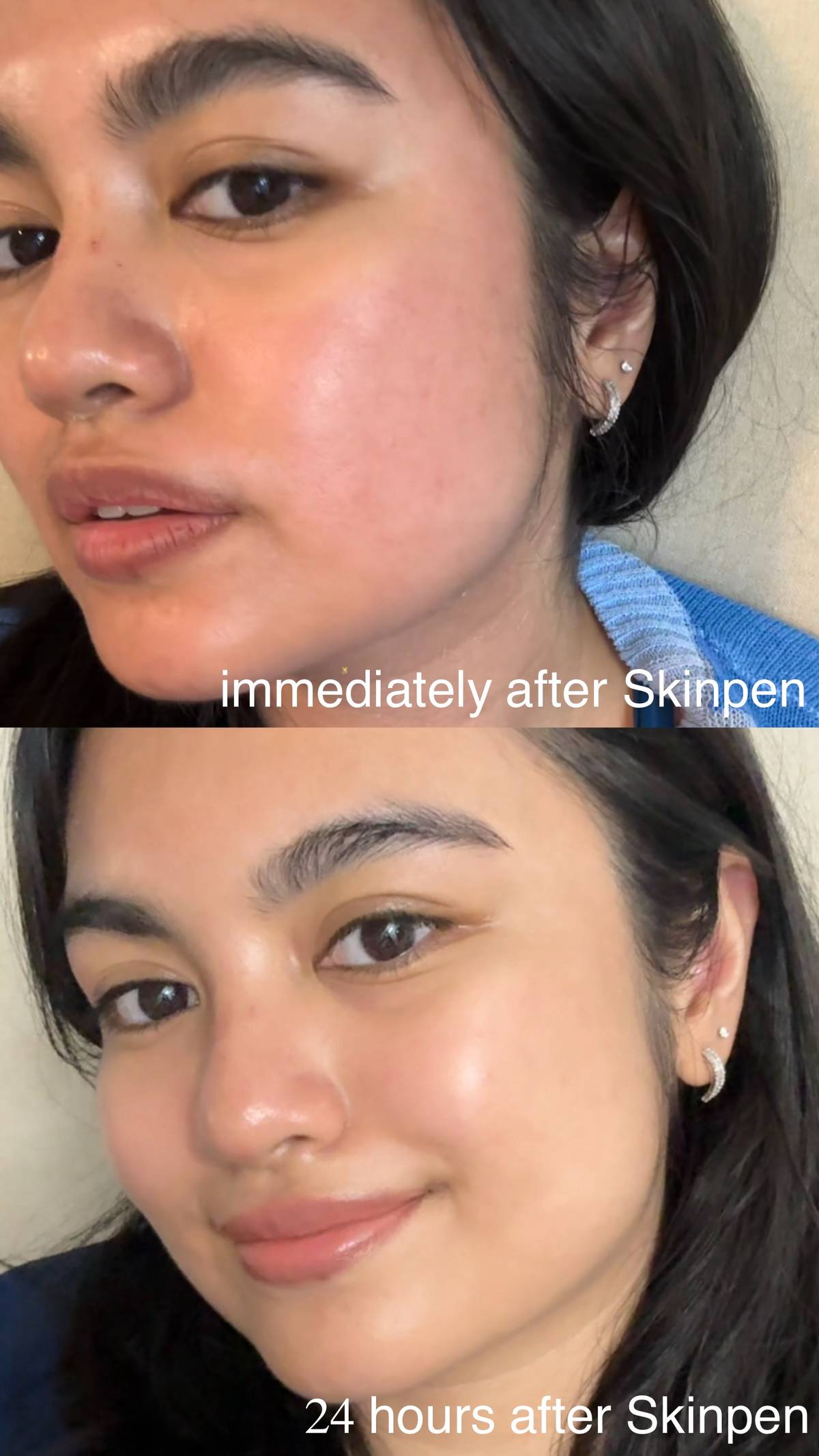Before and after skinpen.