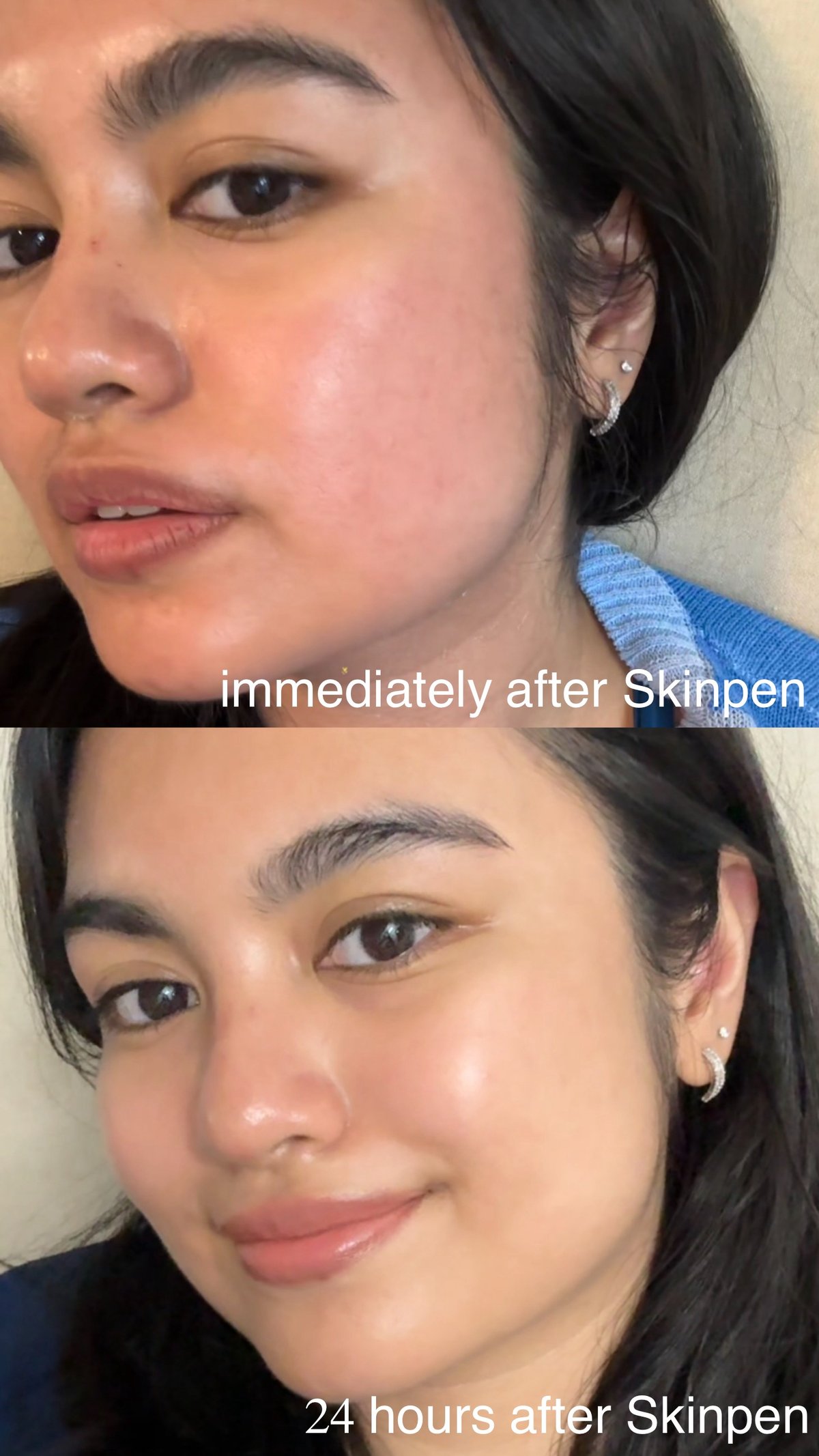 Before and after skinpen.