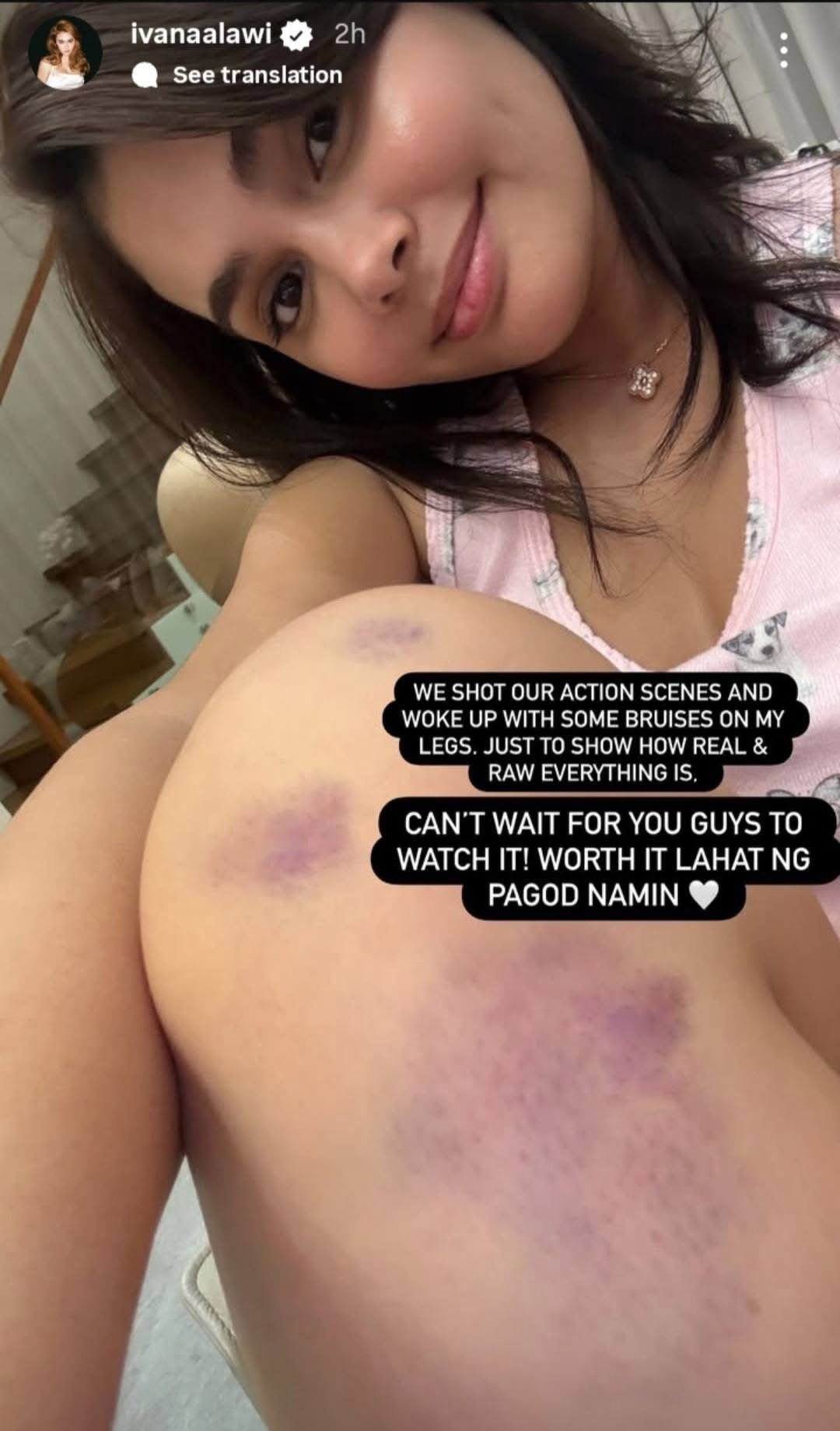 Ivana Alawi wears her battle scars with pride