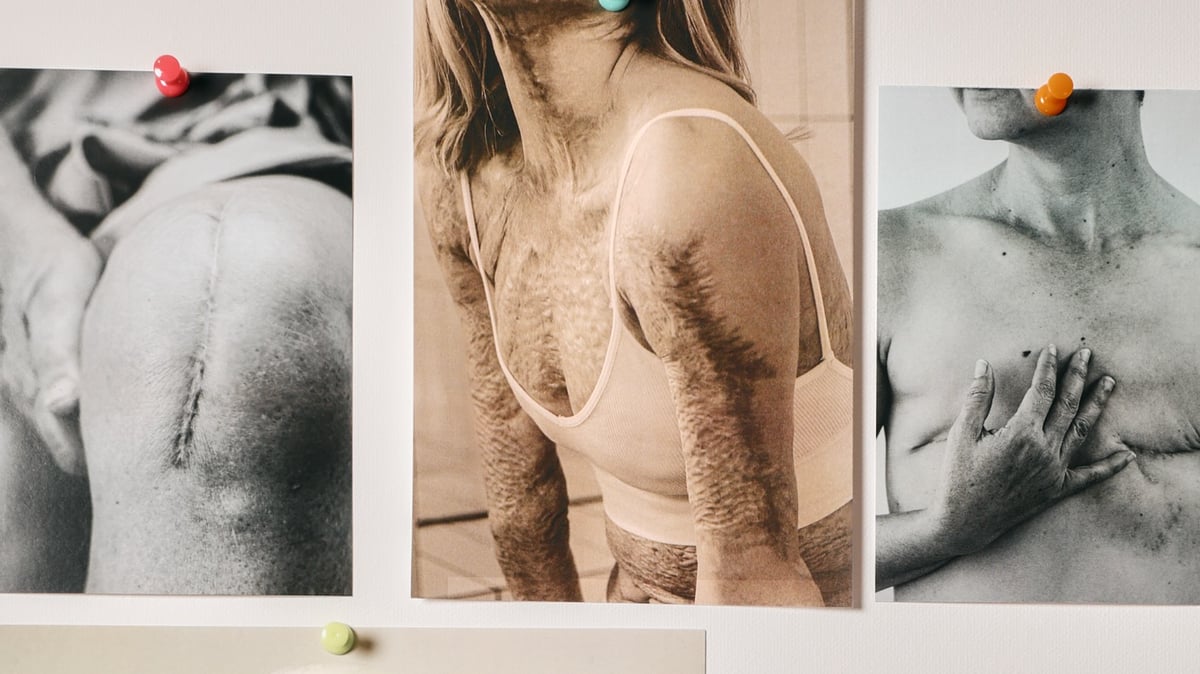 Beyond skin deep: Transforming scars
into stories of hope