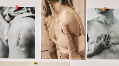 Beyond skin deep: Transforming scars
into stories of hope