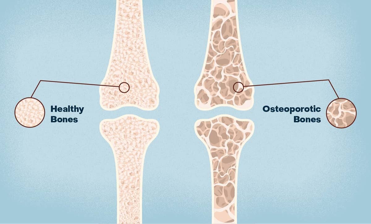 Increasing age increases the risk for developing osteoporosis, but osteoporosis is not a consequence of aging.